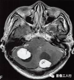 【病例】小脑多发性血管母细胞瘤1例MR影像表现分析 【病例】小脑多发性血管母细胞瘤1例MR影像表现分析