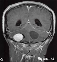 【病例】小脑多发性血管母细胞瘤1例MR影像表现分析 【病例】小脑多发性血管母细胞瘤1例MR影像表现分析
