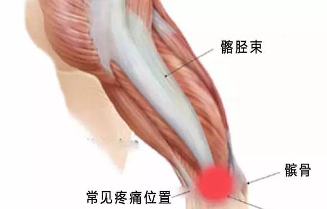 常跑步者膝关节外侧疼痛原因探究——髂胫束摩擦综合症