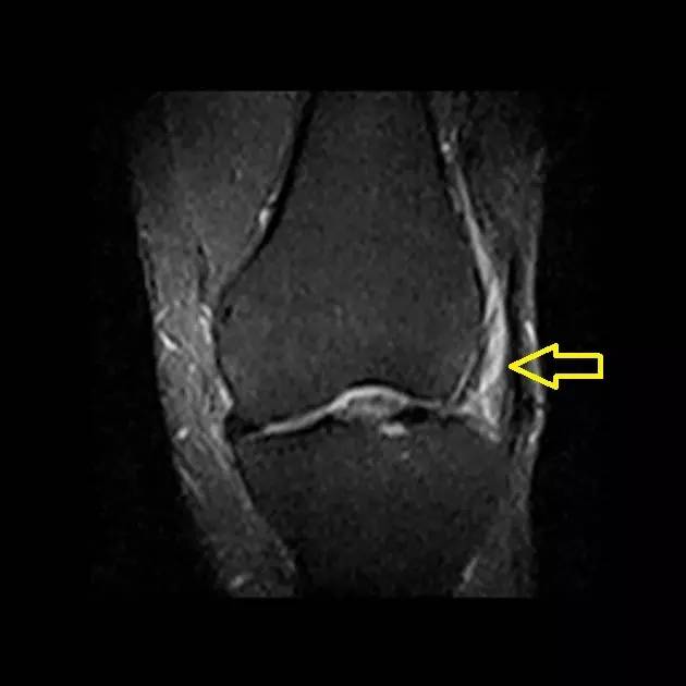 常跑步者膝关节外侧疼痛原因探究——髂胫束摩擦综合症