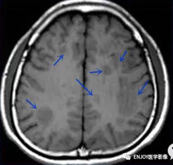 急性播散性脑脊髓炎 急性播散性脑脊髓炎