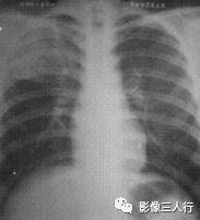 “空气支气管征” 的影像表现与临床意义 “空气支气管征” 的影像表现与临床意义