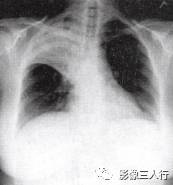 “空气支气管征” 的影像表现与临床意义 “空气支气管征” 的影像表现与临床意义