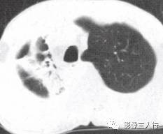 “空气支气管征” 的影像表现与临床意义 “空气支气管征” 的影像表现与临床意义