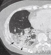 “空气支气管征” 的影像表现与临床意义 “空气支气管征” 的影像表现与临床意义