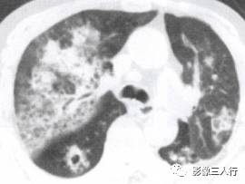 “空气支气管征” 的影像表现与临床意义 “空气支气管征” 的影像表现与临床意义