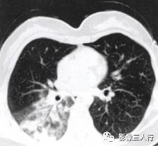 “空气支气管征” 的影像表现与临床意义 “空气支气管征” 的影像表现与临床意义