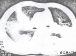 “空气支气管征” 的影像表现与临床意义 “空气支气管征” 的影像表现与临床意义