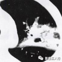 “空气支气管征” 的影像表现与临床意义 “空气支气管征” 的影像表现与临床意义
