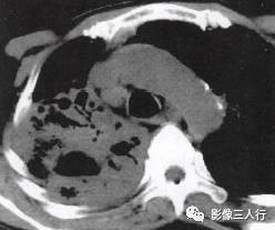“空气支气管征” 的影像表现与临床意义 “空气支气管征” 的影像表现与临床意义
