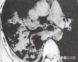 “空气支气管征” 的影像表现与临床意义 “空气支气管征” 的影像表现与临床意义