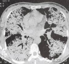 “空气支气管征” 的影像表现与临床意义 “空气支气管征” 的影像表现与临床意义