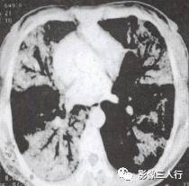 “空气支气管征” 的影像表现与临床意义 “空气支气管征” 的影像表现与临床意义
