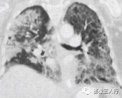 “空气支气管征” 的影像表现与临床意义 “空气支气管征” 的影像表现与临床意义