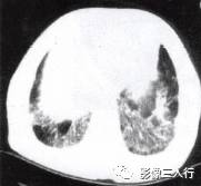 “空气支气管征” 的影像表现与临床意义 “空气支气管征” 的影像表现与临床意义
