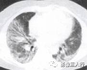 “空气支气管征” 的影像表现与临床意义 “空气支气管征” 的影像表现与临床意义