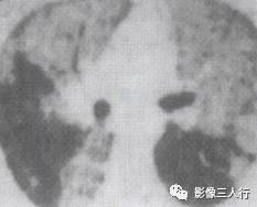 “空气支气管征” 的影像表现与临床意义 “空气支气管征” 的影像表现与临床意义