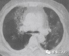“空气支气管征” 的影像表现与临床意义 “空气支气管征” 的影像表现与临床意义