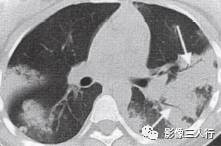 “空气支气管征” 的影像表现与临床意义 “空气支气管征” 的影像表现与临床意义