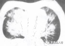 “空气支气管征” 的影像表现与临床意义 “空气支气管征” 的影像表现与临床意义