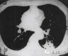 “空气支气管征” 的影像表现与临床意义 “空气支气管征” 的影像表现与临床意义