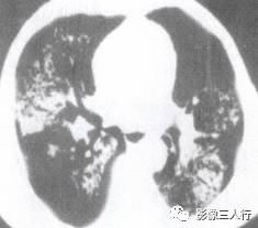 “空气支气管征” 的影像表现与临床意义 “空气支气管征” 的影像表现与临床意义