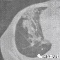 “空气支气管征” 的影像表现与临床意义 “空气支气管征” 的影像表现与临床意义