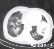 “空气支气管征” 的影像表现与临床意义 “空气支气管征” 的影像表现与临床意义