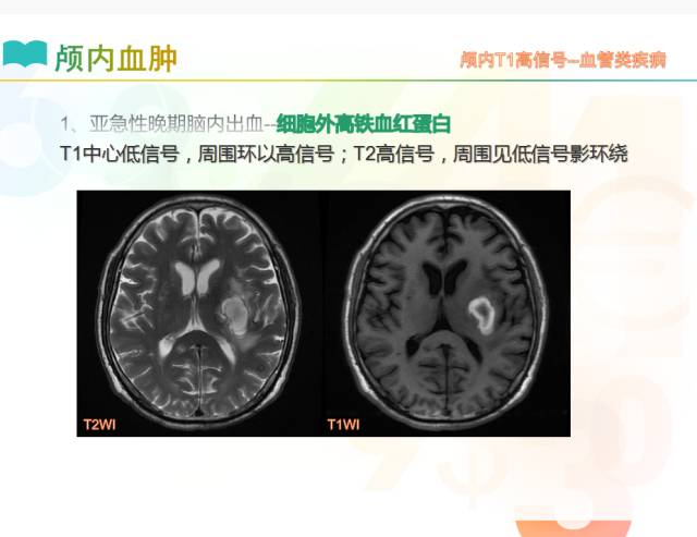 【PPT】颅内T1高信号疾病解读