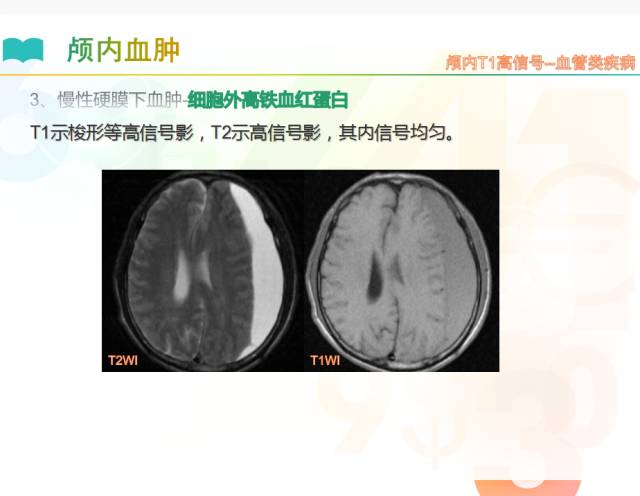 【PPT】颅内T1高信号疾病解读