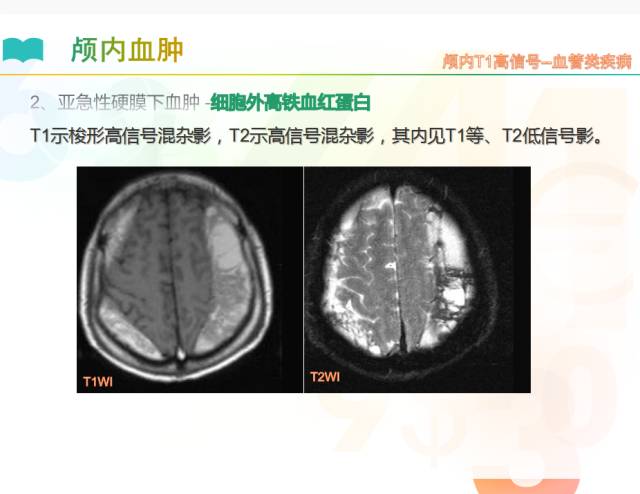 【PPT】颅内T1高信号疾病解读