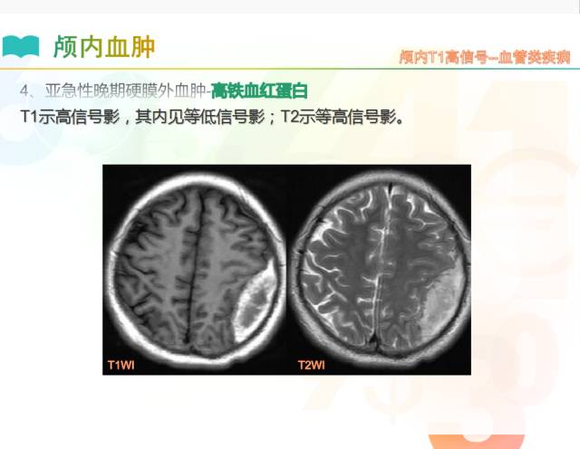 【PPT】颅内T1高信号疾病解读