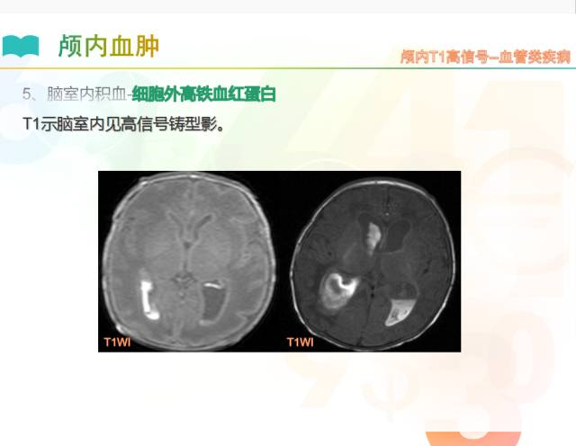 【PPT】颅内T1高信号疾病解读