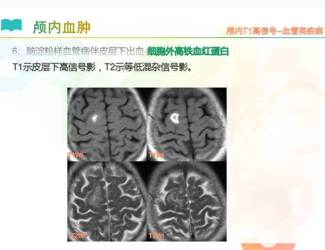 【PPT】颅内T1高信号疾病解读