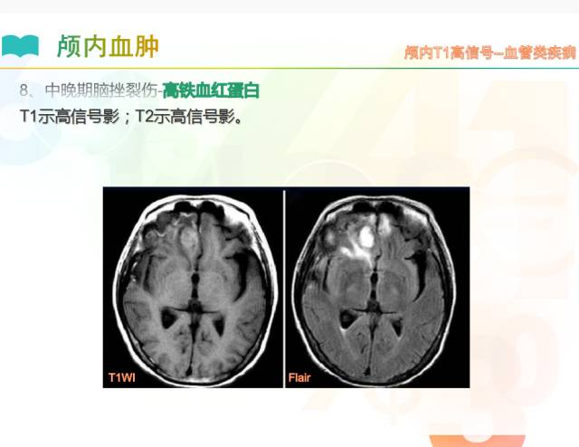 【PPT】颅内T1高信号疾病解读