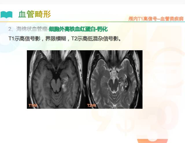 【PPT】颅内T1高信号疾病解读