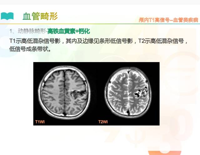 【PPT】颅内T1高信号疾病解读