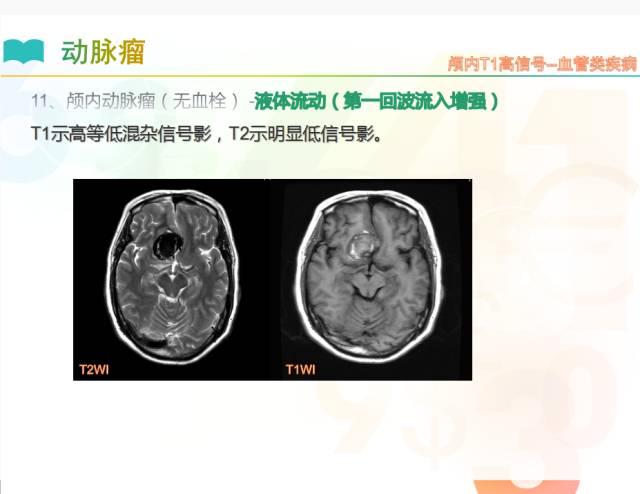 【PPT】颅内T1高信号疾病解读