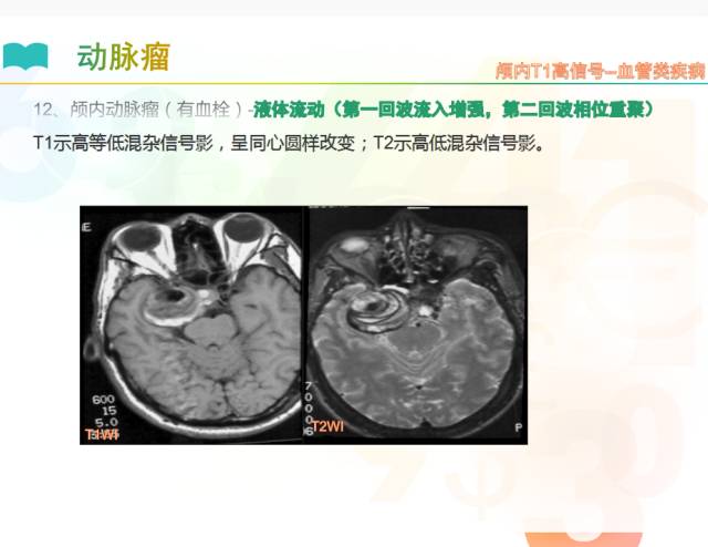 【PPT】颅内T1高信号疾病解读