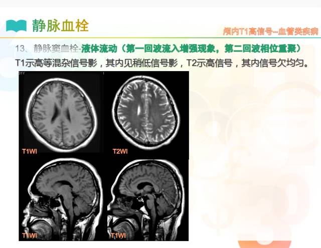 【PPT】颅内T1高信号疾病解读