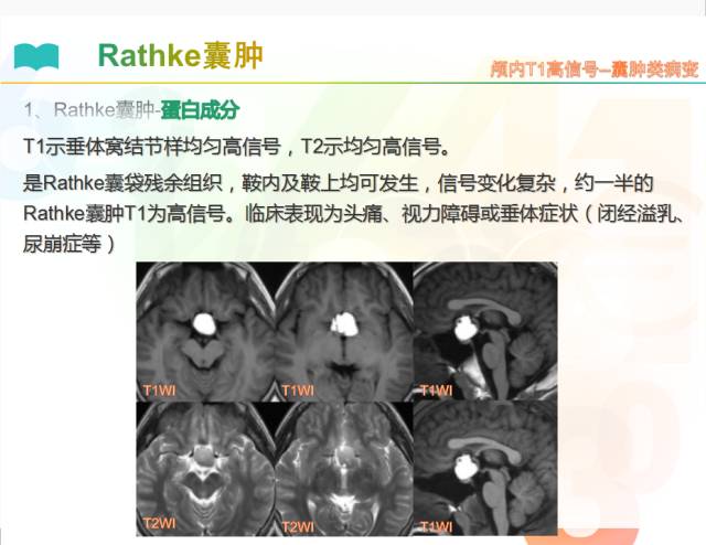【PPT】颅内T1高信号疾病解读