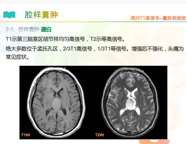 【PPT】颅内T1高信号疾病解读