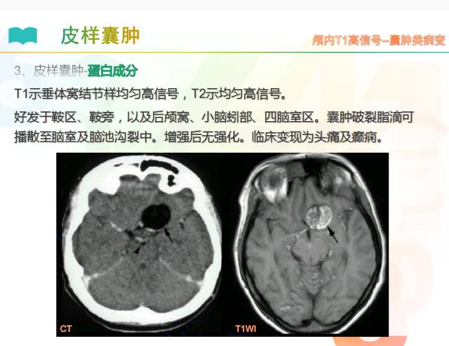 【PPT】颅内T1高信号疾病解读