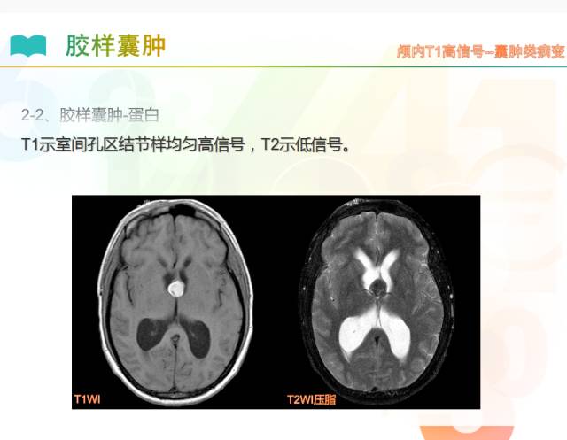 【PPT】颅内T1高信号疾病解读