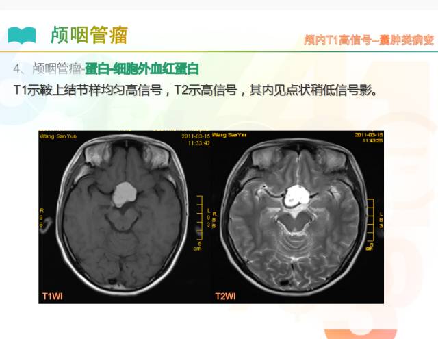 【PPT】颅内T1高信号疾病解读