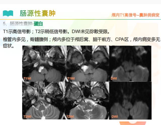 【PPT】颅内T1高信号疾病解读