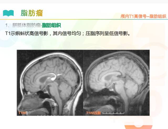 【PPT】颅内T1高信号疾病解读