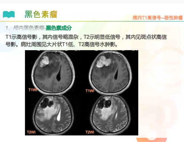 【PPT】颅内T1高信号疾病解读