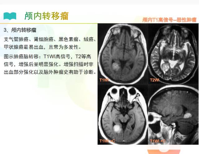 【PPT】颅内T1高信号疾病解读