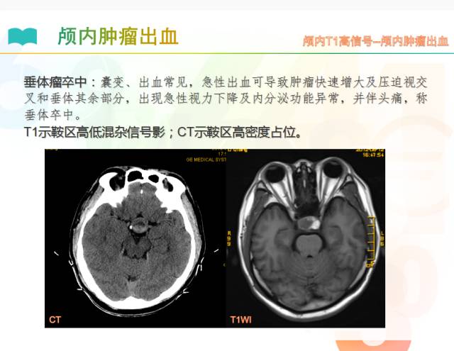 【PPT】颅内T1高信号疾病解读